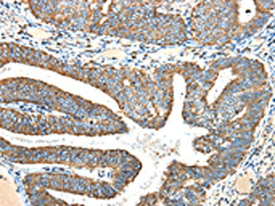 The image on the left is immunohistochemistry of paraffin-embedded Human colon cancer tissue using the antibody Antibody) at dilution 1/40, on the right is treated with fusion protein. (Original magnification: ×200)Rabbit anti-Human NDUFA5 Polyclonal Antibody