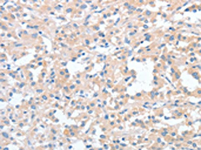 The image is immunohistochemistry of paraffin-embedded Human thyroid cancer tissue using WNT3A Antibody(WNT3A Antibody) at dilution 1/40. (Original magnification: ×200)Rabbit anti-Human WNT3A Polyclonal Antibody