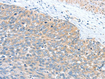The image is immunohistochemistry of paraffin-embedded Human cervical cancer tissue using the antibody Antibody) at dilution 1/40. (Original magnification: ×200)Rabbit anti-Human WNT3A Polyclonal Antibody