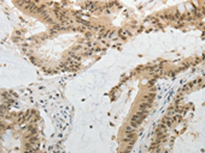 The image on the left is immunohistochemistry of paraffin-embedded Human colon cancer tissue using the antibody Antibody) at dilution 1/20, on the right is treated with fusion protein. (Original magnification: ×200)