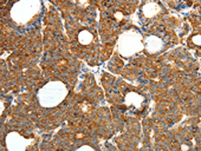 The image on the left is immunohistochemistry of paraffin-embedded Human thyroid cancer tissue using PRDX3 Antibody(PRDX3 Antibody) at dilution 1/20, on the right is treated with fusion protein. (Original magnification: ×200)Rabbit anti-Human PRDX3 Polyclonal Antibody