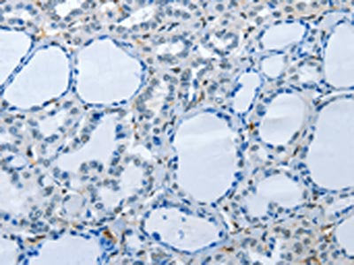 The image on the left is immunohistochemistry of paraffin-embedded Human thyroid cancer tissue using PIK3R2 Antibody(PIK3R2 Antibody) at dilution 1/70, on the right is treated with synthetic peptide. (Original magnification: ×200)Rabbit anti-Human PIK3R2 Polyclonal Antibody