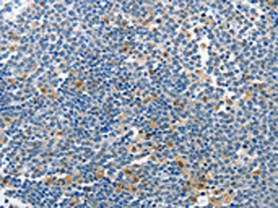 The image on the left is immunohistochemistry of paraffin-embedded Human lymphoma tissue using the antibody Antibody) at dilution 1/70, on the right is treated with synthetic peptide. (Original magnification: ×200)Rabbit anti-Human PIK3R2 Polyclonal Antibody