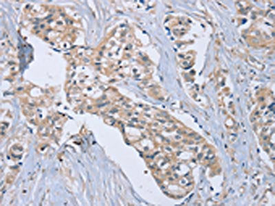 The image on the left is immunohistochemistry of paraffin-embedded Human breast cancer tissue using EDA Antibody(EDA Antibody) at dilution 1/40, on the right is treated with synthetic peptide. (Original magnification: ×200)Rabbit anti-Human EDA Polyclonal Antibody