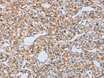 The image on the left is immunohistochemistry of paraffin-embedded Human prostate cancer tissue using the antibody Antibody) at dilution 1/40, on the right is treated with synthetic peptide. (Original magnification: ×200)Rabbit anti-Human EDA Polyclonal Antibody