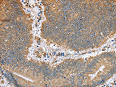 The image on the left is immunohistochemistry of paraffin-embedded Human colon cancer tissue using the antibody Antibody) at dilution 1/50, on the right is treated with fusion protein. (Original magnification: ×200)