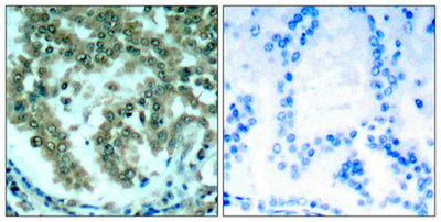 Immunohistochemical analysis of paraffin-embedded human lung carcinoma tissue using PKCth(Ab-676) Antibody(left) or the same antibody preincubated with blocking peptide(right).Rabbit anti-Human PRKCQ Polyclonal Antibody