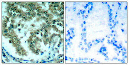 Immunohistochemical analysis of paraffin-embedded human lung carcinoma tissue using PKCth(Ab-676) Antibody(left) or the same antibody preincubated with blocking peptide(right).Rabbit anti-Human PRKCQ Polyclonal Antibody