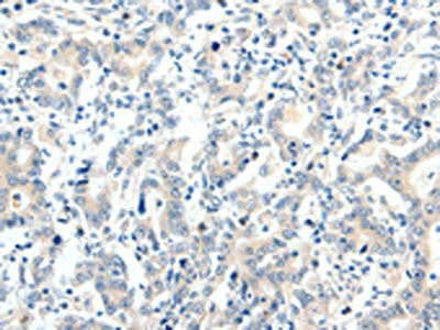 The image on the left is immunohistochemistry of paraffin-embedded Human gastric cancer tissue using TRAF7 Antibody(TRAF7 Antibody) at dilution 1/20, on the right is treated with synthetic peptide. (Original magnification: ×200)Rabbit anti-Human TRAF7 Polyclonal Antibody