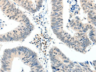 The image on the left is immunohistochemistry of paraffin-embedded Human colon cancer tissue using the antibody Antibody) at dilution 1/20, on the right is treated with synthetic peptide. (Original magnification: ×200)Rabbit anti-Human TRAF7 Polyclonal Antibody