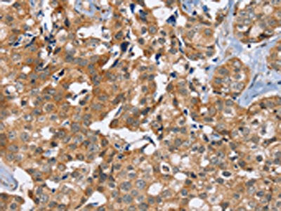 The image on the left is immunohistochemistry of paraffin-embedded Human breast cancer tissue using PHYH Antibody(PHYH Antibody) at dilution 1/20, on the right is treated with fusion protein. (Original magnification: ×200)Rabbit anti-Human PHYH Polyclonal Antibody