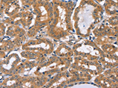 The image on the left is immunohistochemistry of paraffin-embedded Human thyroid cancer tissue using the antibody Antibody) at dilution 1/20, on the right is treated with fusion protein. (Original magnification: ×200)Rabbit anti-Human PHYH Polyclonal Antibody
