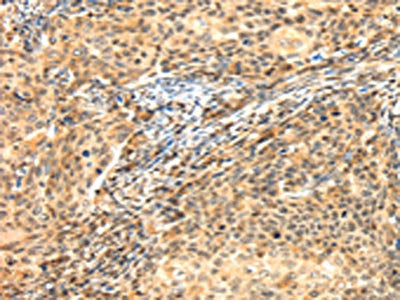 The image on the left is immunohistochemistry of paraffin-embedded Human cervical cancer tissue using AGPAT9 Antibody(AGPAT9 Antibody) at dilution 1/25, on the right is treated with synthetic peptide. (Original magnification: ×200)Rabbit anti-Human AGPAT9 Polyclonal Antibody
