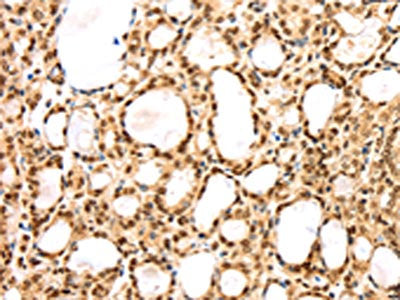 The image on the left is immunohistochemistry of paraffin-embedded Human thyroid cancer tissue using the antibody Antibody) at dilution 1/25, on the right is treated with synthetic peptide. (Original magnification: ×200)Rabbit anti-Human AGPAT9 Polyclonal Antibody