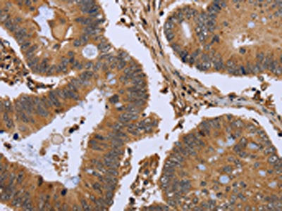 The image on the left is immunohistochemistry of paraffin-embedded Human colon cancer tissue using FHL2 Antibody(FHL2 Antibody) at dilution 1/50, on the right is treated with fusion protein. (Original magnification: ×200)Rabbit anti-Human FHL2 Polyclonal Antibody