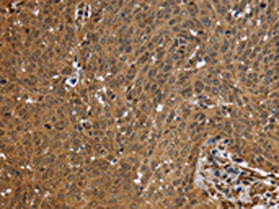 The image on the left is immunohistochemistry of paraffin-embedded Human cervical cancer tissue using the antibody Antibody) at dilution 1/50, on the right is treated with fusion protein. (Original magnification: ×200)Rabbit anti-Human FHL2 Polyclonal Antibody