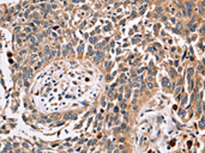 The image on the left is immunohistochemistry of paraffin-embedded Human lung cancer tissue using FUCA1 Antibody(FUCA1 Antibody) at dilution 1/30, on the right is treated with fusion protein. (Original magnification: ×200)Rabbit anti-Human FUCA1 Polyclonal Antibody