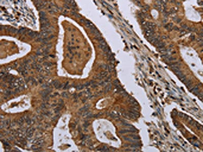 The image on the left is immunohistochemistry of paraffin-embedded Human colon cancer tissue using MIG7 Antibody(MIG7   Antibody) at dilution 1/35, on the right is treated with synthetic peptide. (Original magnification: ×200)