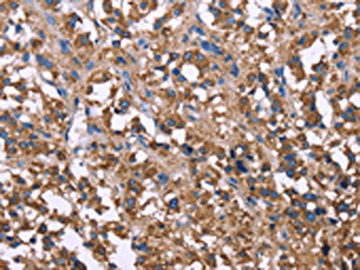 The image on the left is immunohistochemistry of paraffin-embedded Human thyroid cancer tissue using the antibody Antibody) at dilution 1/30, on the right is treated with synthetic peptide. (Original magnification: ×200)