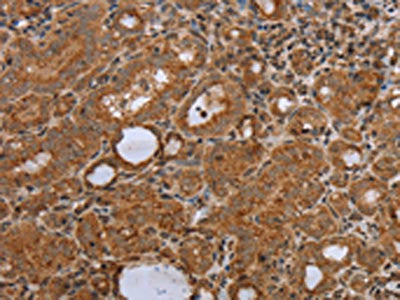 The image on the left is immunohistochemistry of paraffin-embedded Human thyroid cancer tissue using NDUFS2 Antibody(NDUFS2 Antibody) at dilution 1/50, on the right is treated with synthetic peptide. (Original magnification: ×200)Rabbit anti-Human NDUFS2 Polyclonal Antibody