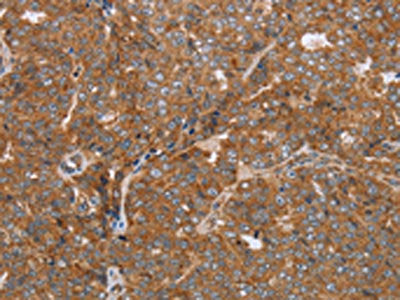 The image on the left is immunohistochemistry of paraffin-embedded Human ovarian cancer tissue using the antibody Antibody) at dilution 1/50, on the right is treated with synthetic peptide. (Original magnification: ×200)Rabbit anti-Human NDUFS2 Polyclonal Antibody