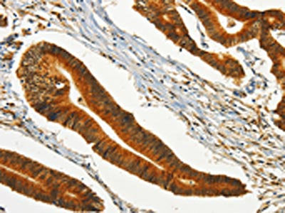 The image on the left is immunohistochemistry of paraffin-embedded Human colon cancer tissue using CHRDL2 Antibody(CHRDL2 Antibody) at dilution 1/20, on the right is treated with synthetic peptide. (Original magnification: ×200)Rabbit anti-Human CHRDL2 Polyclonal Antibody