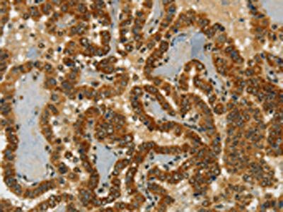The image on the left is immunohistochemistry of paraffin-embedded Human thyroid cancer tissue using the antibody Antibody) at dilution 1/20, on the right is treated with synthetic peptide. (Original magnification: ×200)Rabbit anti-Human CHRDL2 Polyclonal Antibody