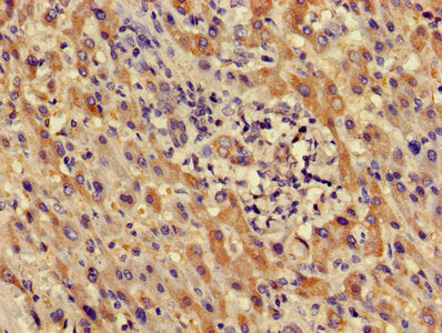 Immunohistochemistry of paraffin-embedded human liver cancer using LDHD Antibody at dilution of 1:100