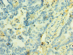 Immunohistochemistry of paraffin-embedded human lung cancer using the antibody at dilution of 1:100Rabbit anti-Human STX12 Polyclonal Antibody