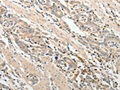 The image on the left is immunohistochemistry of paraffin-embedded Human gastric cancer  tissue using ADAMTS2 Antibody(ADAMTS2 Antibody) at dilution 1/25, on the right is treated with synthetic peptide. (Original magnification: ×200)