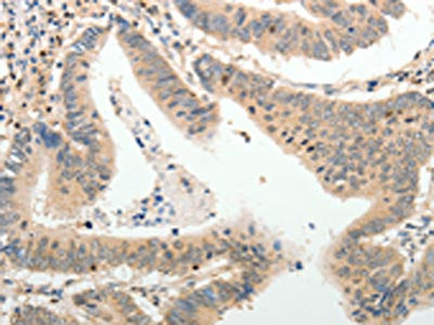 The image on the left is immunohistochemistry of paraffin-embedded Human colon cancer  tissue using the antibody Antibody) at dilution 1/25, on the right is treated with synthetic peptide. (Original magnification: ×200)