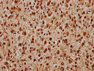 IHC image of TIPARP Antibody diluted at 1:300 and staining in paraffin-embedded human glioma performed on a Leica BondTM system. After dewaxing and hydration, antigen retrieval was mediated by high pressure in a citrate buffer (pH 6.0). Section was blocked with 10% normal goat serum 30min at RT. Then primary antibody (1% BSA) was incubated at 4°C overnight. The primary is detected by a biotinylated secondary antibody and visualized using an HRP conjugated SP system.Rabbit anti-Human TIPARP Polyclonal Antibody
