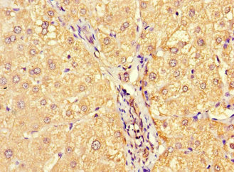 Immunohistochemistry of paraffin-embedded human liver cancer using MILR1 Antibody at dilution of 1:100