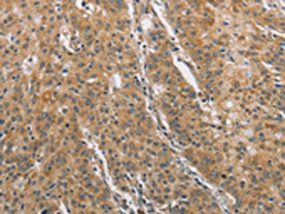 The image on the left is immunohistochemistry of paraffin-embedded Human gastric cancer tissue using DDX53 Antibody(DDX53 Antibody) at dilution 1/75, on the right is treated with fusion protein. (Original magnification: ×200)Rabbit anti-Human DDX53 Polyclonal Antibody
