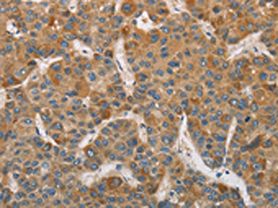 The image on the left is immunohistochemistry of paraffin-embedded Human liver cancer tissue using the antibody Antibody) at dilution 1/75, on the right is treated with fusion protein. (Original magnification: ×200)Rabbit anti-Human DDX53 Polyclonal Antibody