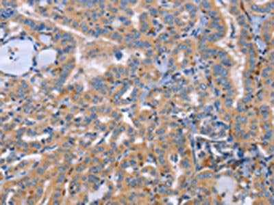 The image on the left is immunohistochemistry of paraffin-embedded Human thyroid cancer tissue using SIGLEC7 Antibody(SIGLEC7 Antibody) at dilution 1/50, on the right is treated with synthetic peptide. (Original magnification: ×200)Rabbit anti-Human SIGLEC7 Polyclonal Antibody