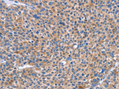 The image on the left is immunohistochemistry of paraffin-embedded Human liver cancer tissue using the antibody Antibody) at dilution 1/50, on the right is treated with synthetic peptide. (Original magnification: ×200)Rabbit anti-Human SIGLEC7 Polyclonal Antibody