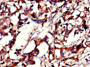 Immunohistochemistry of paraffin-embedded human gastric cancer using PHLDB2 Antibody at dilution of 1:100Rabbit anti-Human PHLDB2 Polyclonal Antibody