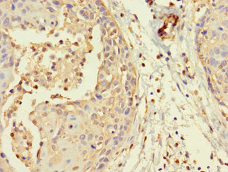 Immunohistochemistry of paraffin-embedded human cervical cancer using MORC1 Antibody at dilution of 1:100Rabbit anti-Human MORC1 Polyclonal Antibody