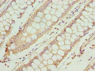 Immunohistochemistry of paraffin-embedded human colon cancer using TTC30A Antibody at dilution of 1:100Rabbit anti-Human TTC30A Polyclonal Antibody