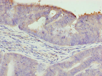 Immunohistochemistry of paraffin-embedded human endometrial cancer using TTC30A Antibody at dilution of 1:100Rabbit anti-Human TTC30A Polyclonal Antibody