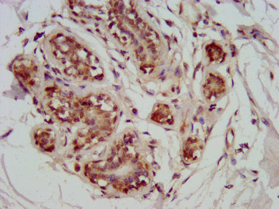 IHC image of GATAD2A Antibody diluted at 1:800 and staining in paraffin-embedded human breast cancer performed on a Leica BondTM system. After dewaxing and hydration, antigen retrieval was mediated by high pressure in a citrate buffer (pH 6.0). Section was blocked with 10% normal goat serum 30min at RT. Then primary antibody (1% BSA) was incubated at 4°C overnight. The primary is detected by a biotinylated secondary antibody and visualized using an HRP conjugated SP system.Rabbit anti-Human GATAD2A Polyclonal Antibody