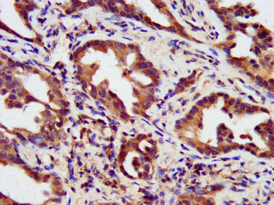 IHC image of HIPK1 Antibody diluted at 1:200 and staining in paraffin-embedded human lung cancer performed on a Leica BondTM system. After dewaxing and hydration, antigen retrieval was mediated by high pressure in a citrate buffer (pH 6.0). Section was blocked with 10% normal goat serum 30min at RT. Then primary antibody (1% BSA) was incubated at 4°C overnight. The primary is detected by a biotinylated secondary antibody and visualized using an HRP conjugated SP system.Rabbit anti-Human HIPK1 Polyclonal Antibody