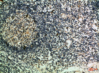 Immunohistochemical analysis of paraffin-embedded Human-lymph, antibody was diluted at 1:100Rabbit anti-Human GZMM Polyclonal Antibody
