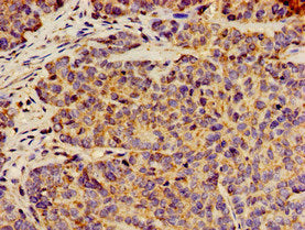 Immunohistochemistry of paraffin-embedded human ovarian cancer using the antibody at dilution of 1:100Rabbit anti-Human ANO1 Polyclonal Antibody