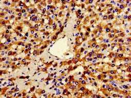 Immunohistochemistry of paraffin-embedded human liver cancer using ANO1 Antibody at dilution of 1:100Rabbit anti-Human ANO1 Polyclonal Antibody