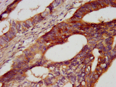 IHC image of CDH7 Antibody diluted at 1:400 and staining in paraffin-embedded human colon cancer performed on a Leica BondTM system. After dewaxing and hydration, antigen retrieval was mediated by high pressure in a citrate buffer (pH 6.0). Section was blocked with 10% normal goat serum 30min at RT. Then primary antibody (1% BSA) was incubated at 4°C overnight. The primary is detected by a biotinylated secondary antibody and visualized using an HRP conjugated SP system.Rabbit anti-Human CDH7 Polyclonal Antibody