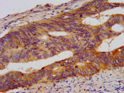 IHC image of Wdr37 Antibody diluted at 1:500 and staining in paraffin-embedded human colon cancer performed on a Leica BondTM system. After dewaxing and hydration, antigen retrieval was mediated by high pressure in a citrate buffer (pH 6.0). Section was blocked with 10% normal goat serum 30min at RT. Then primary antibody (1% BSA) was incubated at 4°C overnight. The primary is detected by a biotinylated secondary antibody and visualized using an HRP conjugated SP system.Rabbit anti-Mus musculus (Mouse) Wdr37 Polyclonal Antibody