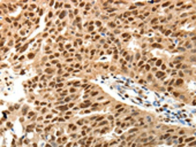 The image on the left is immunohistochemistry of paraffin-embedded Human ovarian cancer tissue using SPATA2L Antibody(SPATA2L Antibody) at dilution 1/30, on the right is treated with fusion protein. (Original magnification: ×200)Rabbit anti-Human SPATA2L Polyclonal Antibody