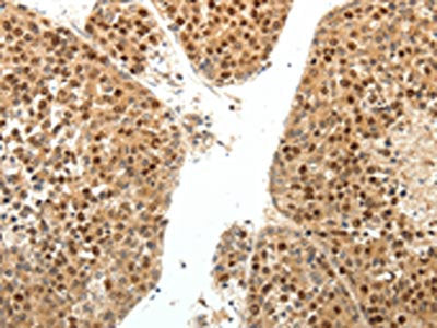 The image on the left is immunohistochemistry of paraffin-embedded Human liver cancer tissue using the antibody Antibody) at dilution 1/30, on the right is treated with fusion protein. (Original magnification: ×200)Rabbit anti-Human SPATA2L Polyclonal Antibody